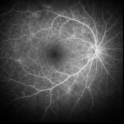 OD Angiography